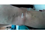 DR FLEBOLOGO DE VARICES EN LUQUE PARAGUAY PROF DR CANATA ESPECUALISTA DE VARICES CON LASER