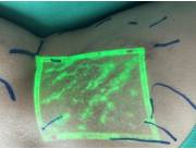 CENTROPARAGUAYO DE VARICES CON LASER ATENCION DE VARICES TRATAMIENTOS CON LASER