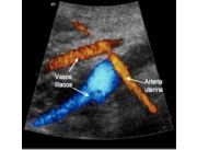 ECOGRAFIA DOPPLER MATERNO FETAL