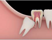Extracción de terceros molares o dientes de juicio