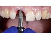 Implantes dentales con facilidad de pagos