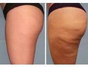 Tratamientos anti celulitis y grasa localizada